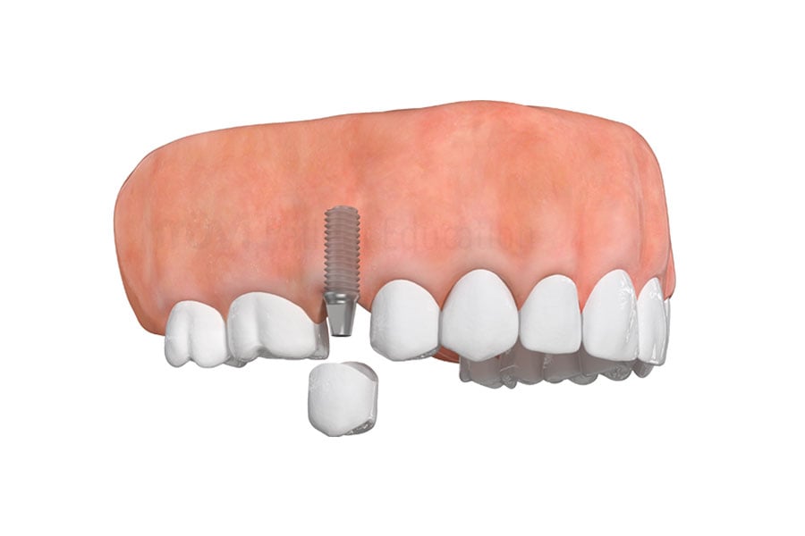 Dental Implant in Citrus Heights, CA