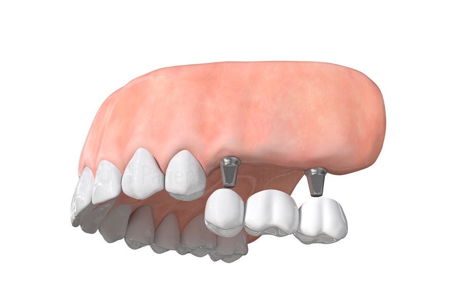 Implant Bridge in Citrus Heights, CA