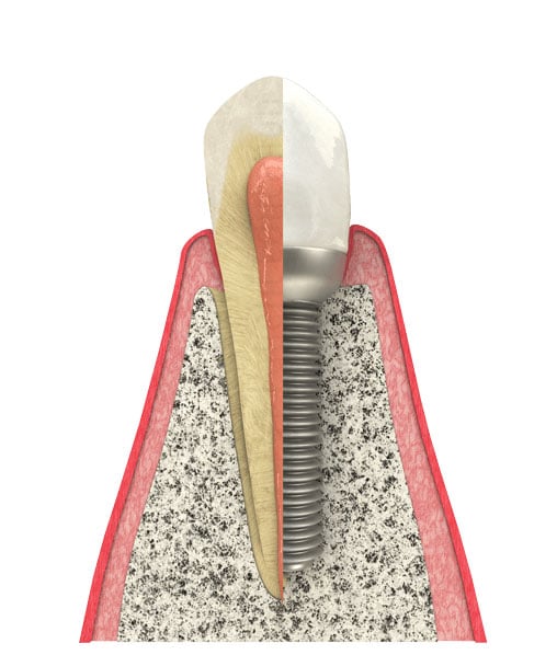 Dental Implant in Citrus Heights, CA