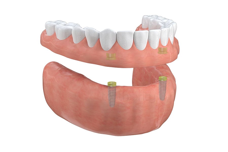 Implant-Supported Overdentures in Citrus Heights, CA