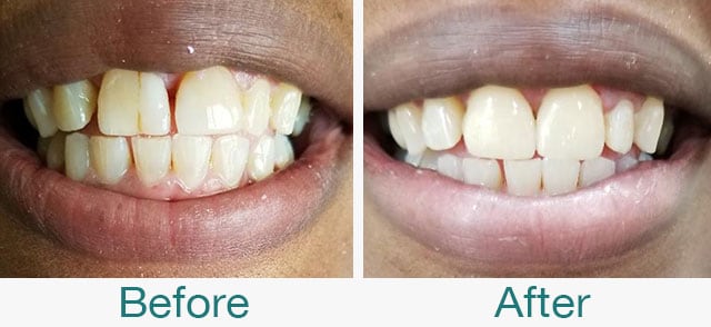 Before & After Photos at Pristine Family Dentistry in Citrus Heights, CA