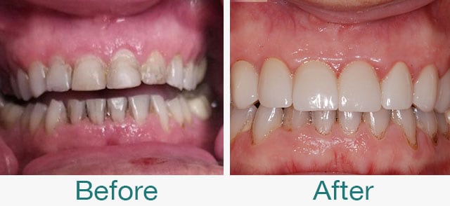 Before & After Photos at Pristine Family Dentistry in Citrus Heights, CA