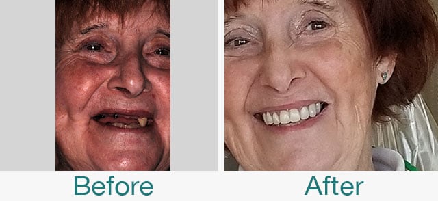 Take a look at our before and after photos in Citrus Heights, CA. Schedule a dental appointment with Dr. Nathalie Selvanathan and Dr. Karthik Raghuraman, recommended cosmetic dentists near Citrus Heights CA, to help you get a brighter and healthier smile than ever before with exceptional cosmetic procedures in 95610! Before & After Photos at Pristine Family Dentistry in Citrus Heights, CA