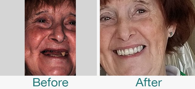 Before & After Photos at Pristine Family Dentistry in Citrus Heights, CA