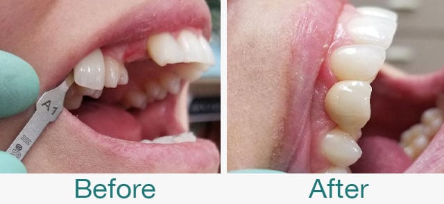 Take a look at our before and after photos in Citrus Heights, CA. Schedule a dental appointment with Dr. Nathalie Selvanathan and Dr. Karthik Raghuraman, recommended cosmetic dentists near Citrus Heights CA, to help you get a brighter and healthier smile than ever before with exceptional cosmetic procedures in 95610! Before & After Photos at Pristine Family Dentistry in Citrus Heights, CA