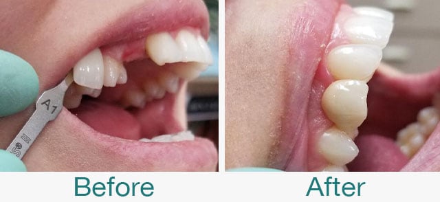 Before & After Photos at Pristine Family Dentistry in Citrus Heights, CA