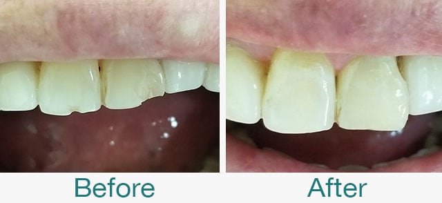 Before & After Photos at Pristine Family Dentistry in Citrus Heights, CA